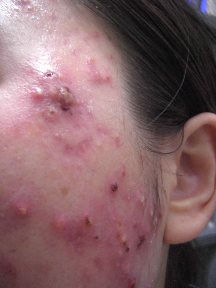 毛囊炎、疖和疖病的发病机制、临床表现和治疗原则