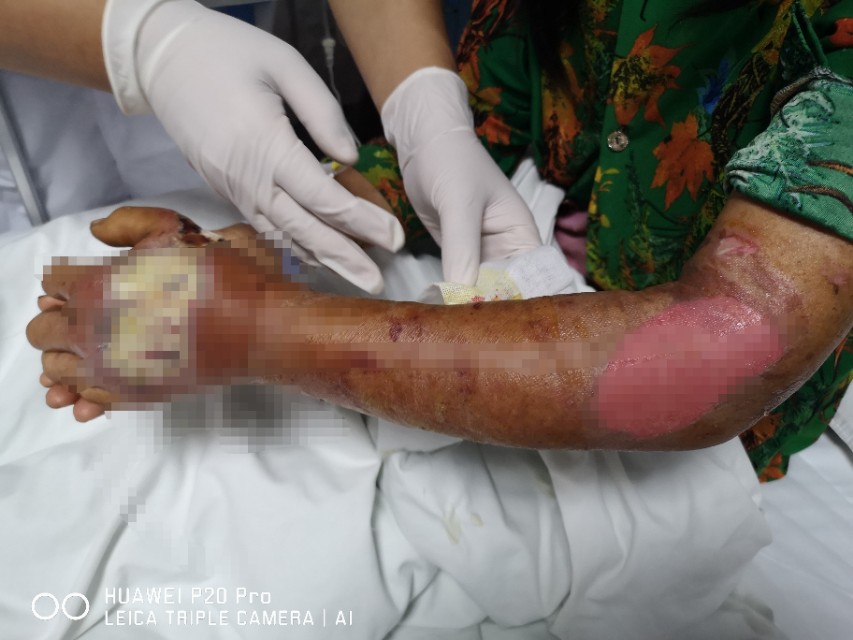 眼镜蛇咬伤急救现场视频,被眼镜蛇咬了怎么办急救