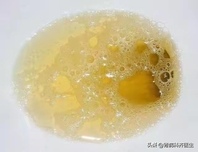 肾小球性血尿是什么意思能治好吗,血尿怎么判断是肾病