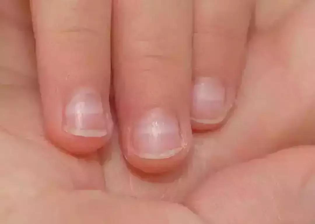 十岁孩子指甲上有竖纹是怎么回事,大拇指甲上有白色竖纹是怎么回事