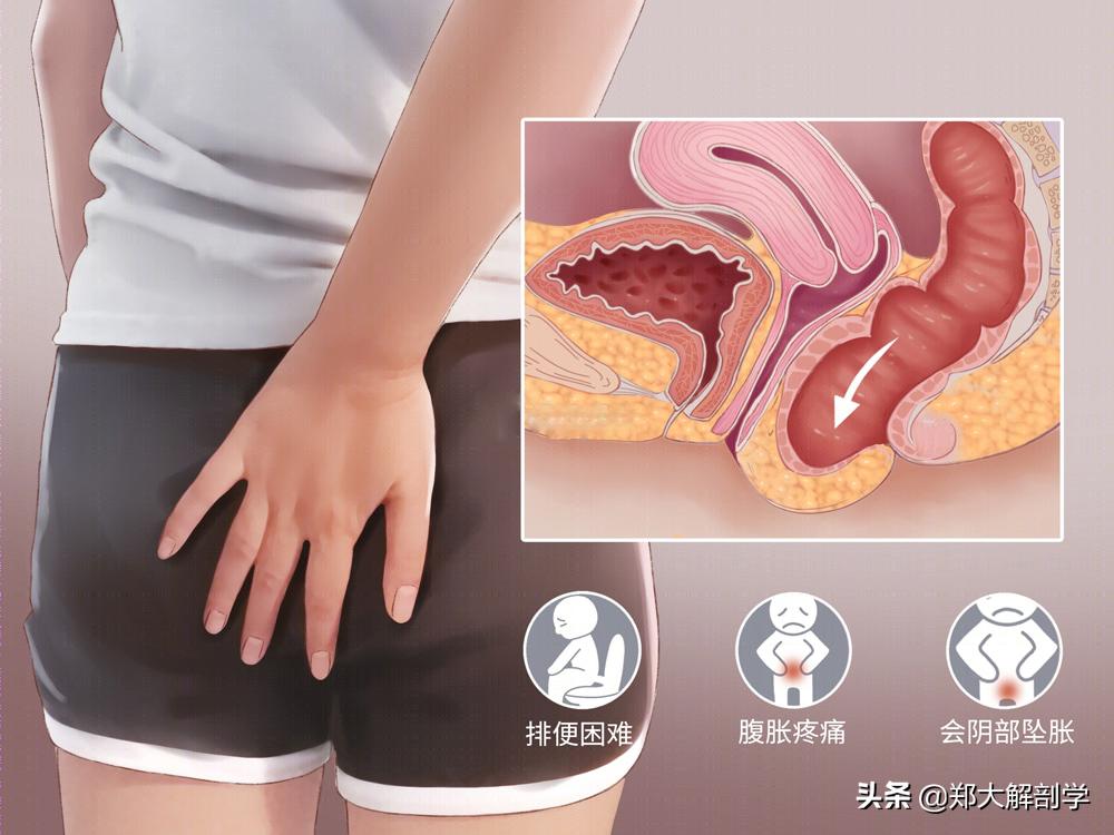 女性盆底功能障碍性疾病表现,南通治疗盆底功能障碍的医院