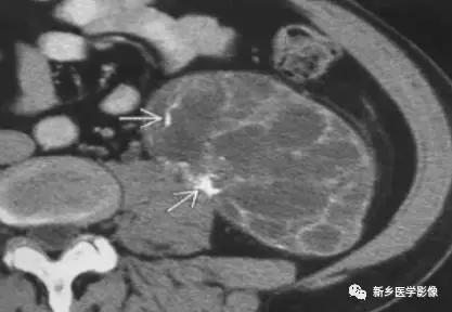 腹部平片能看到结石吗,腹部高密度结节影是什么
