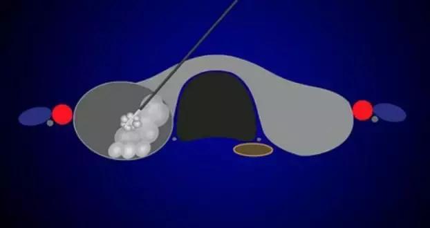 甲状腺良性结节的微创治疗