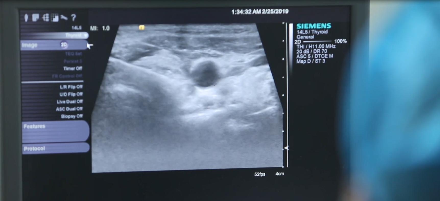 甲亢眼睛突真实案例,甲亢现状