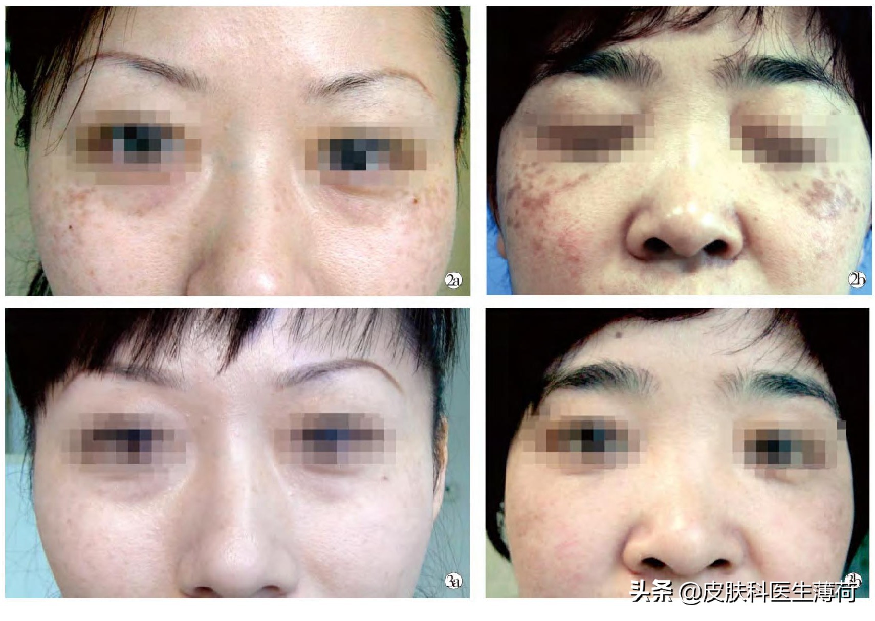 脸上有斑是做冷冻还是激光,黄褐斑用激光祛好还是吃中药