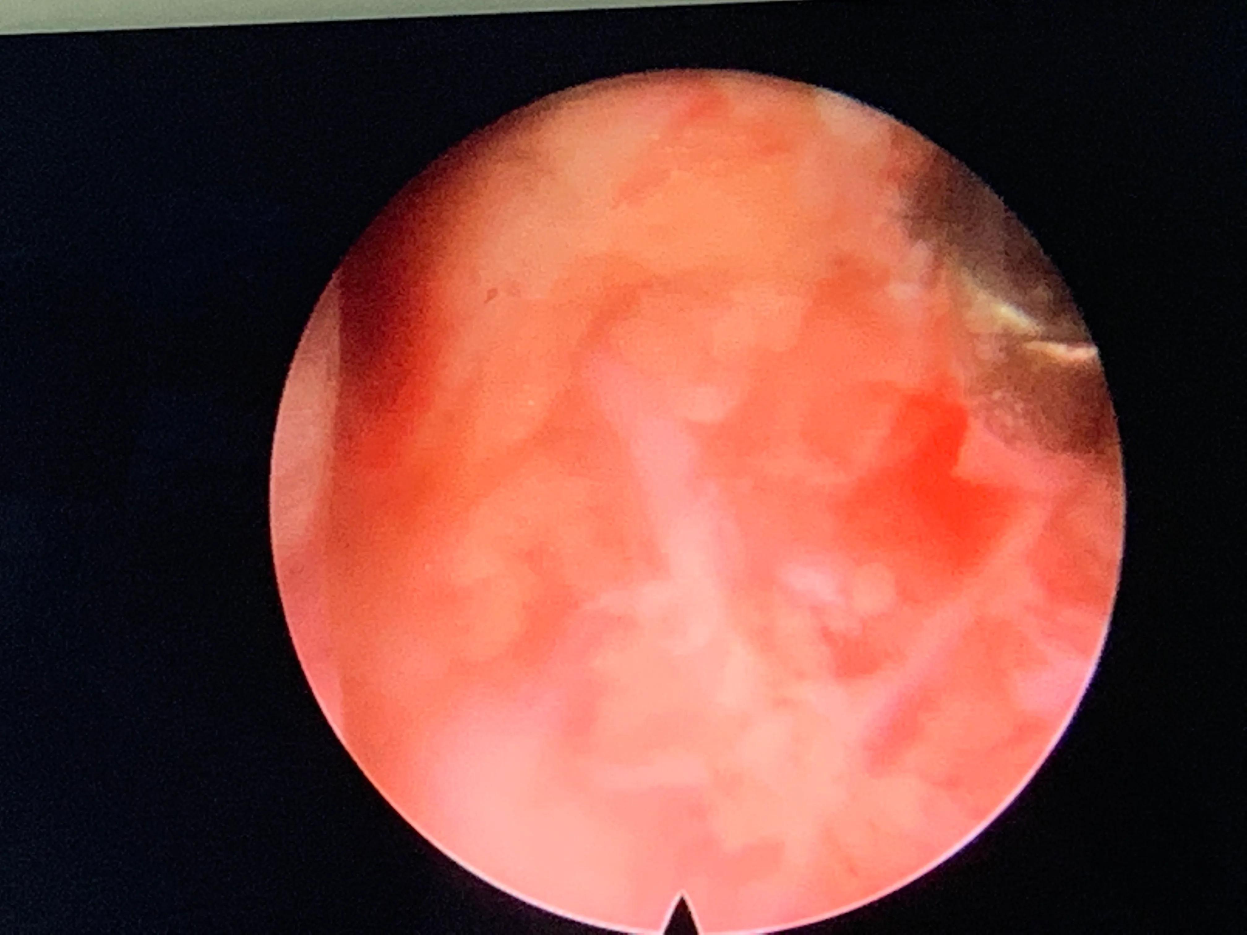 椎间孔镜术后腰痛症状多久消失,盘源性腰痛手术后易复发吗