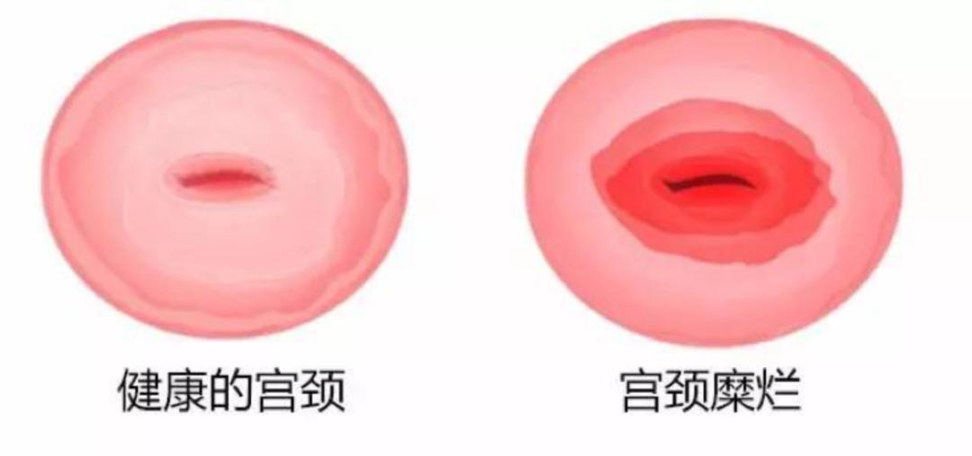 宫颈糜烂吃什么药可以快速治愈,女性宫颈糜烂是什么原因引起的