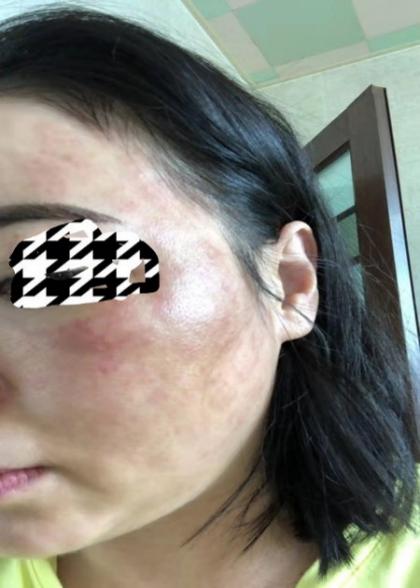 一次水光针相当于敷了1000次面膜,一次水光针等于10次补水