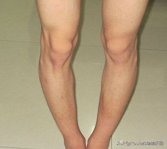 “翘臀”还有假?先自测再确认:你是真“翘臀”还是骨盆前倾?