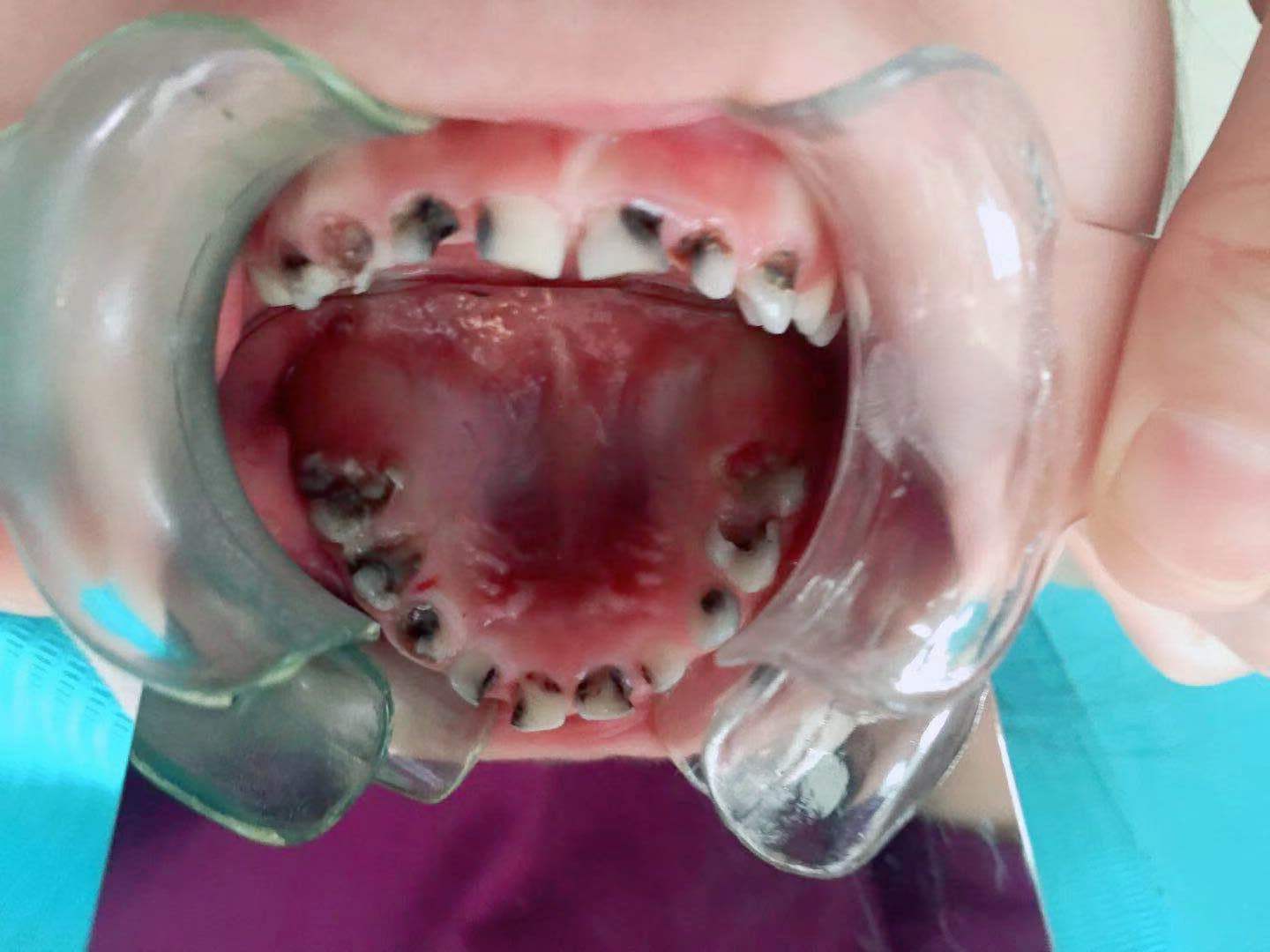 乳牙龋齿治疗会痛吗,三岁多宝宝牙齿龋齿严重怎么治疗