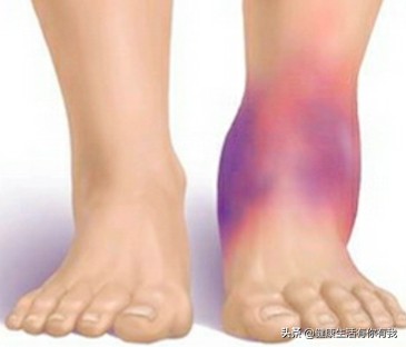 急性踝关节扭伤针灸特效穴,踝关节扭伤最新指南