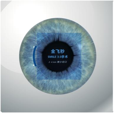 全飞秒激光smile3.0近视手术,全飞秒smile与smile3.0的区别