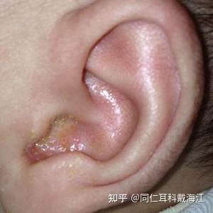 油耳朵的油是怎么来的？