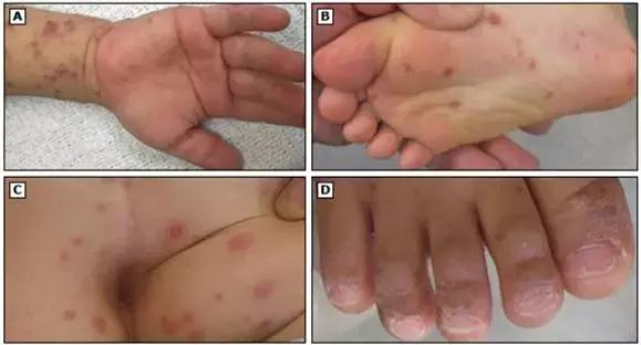 幼儿手足口病怎么传染的动画解说,手足口病儿童动画视频