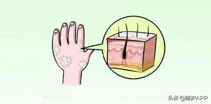 hiv的小红疹长什么样,hiv的小红点是病毒疹吗