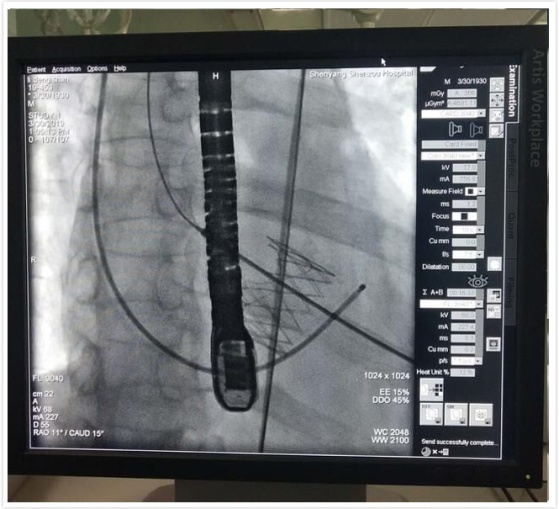 心血管病患者新希望——沈医二院成功完成一例TAVI手术