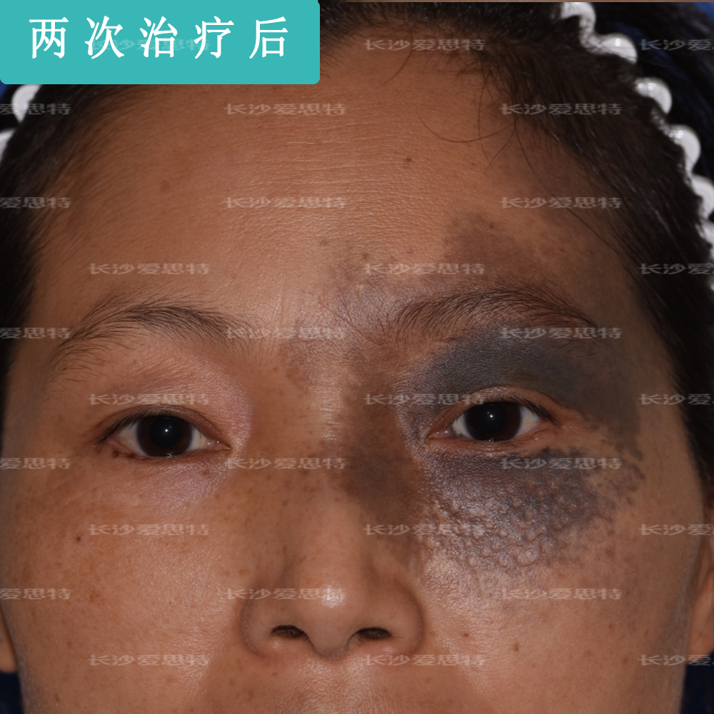 激光祛太田痣视频,疤痕太田痣皮秒激光祛斑恢复过程