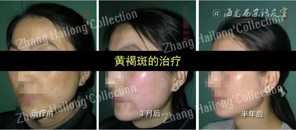 褐斑治疗,褐斑怎么办