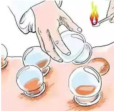 拔罐的知识与视频解说,拔罐如何从罐印判断身体好坏