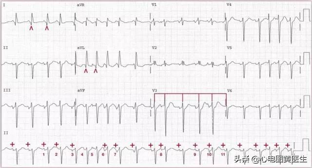 心电图分析为室性心律,房室性心动过速心电图图片