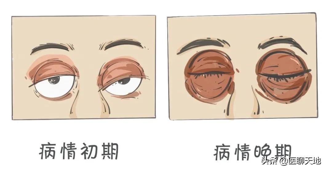 儿童眼睑浮肿要警惕三种病,中医说眼睑水肿