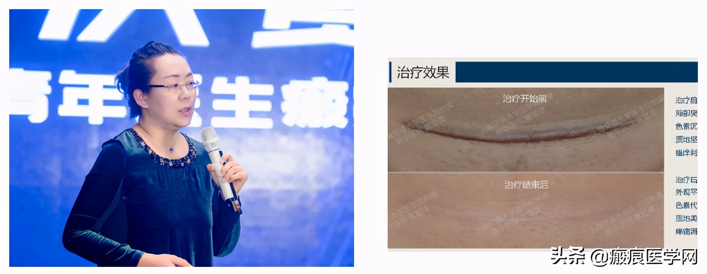 鐦㈢棔妗堜緥,鐤ょ棔娌荤枟鎴愬姛妗堜緥