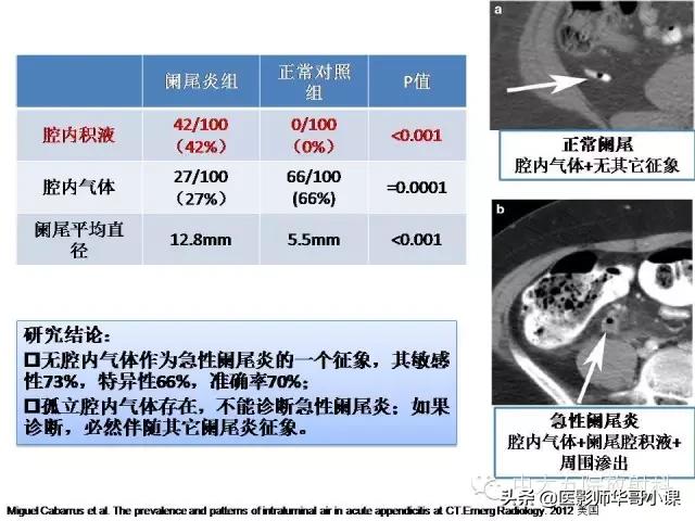阑尾炎课件,阑尾炎的超声课件