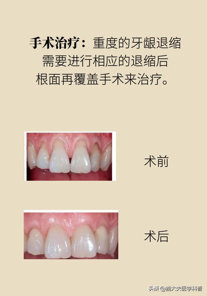 牙根暴露了该怎么刷牙,牙根治疗后可以刷牙吗