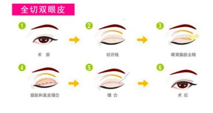 常见的几种双眼皮,常见双眼皮的手术方法及利弊