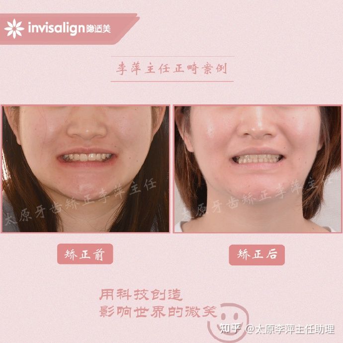 太原矫正牙齿需要做正颌吗,太原牙齿二次矫正