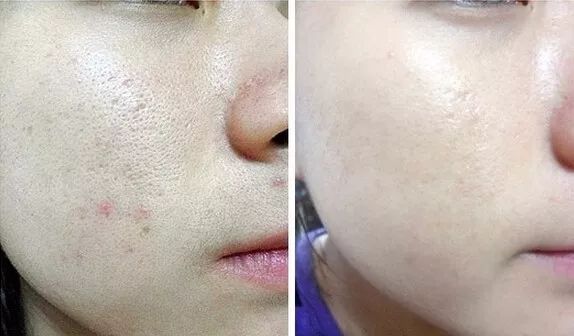 长黑头VS不长黑头差距这么大?精致女孩如何绕过黑头这道坎?