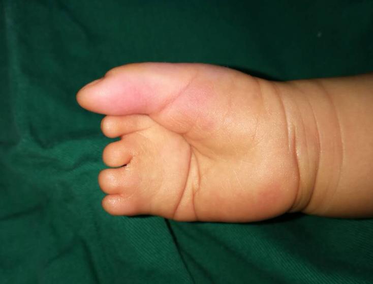 并指畸形免植皮案例,并指畸形