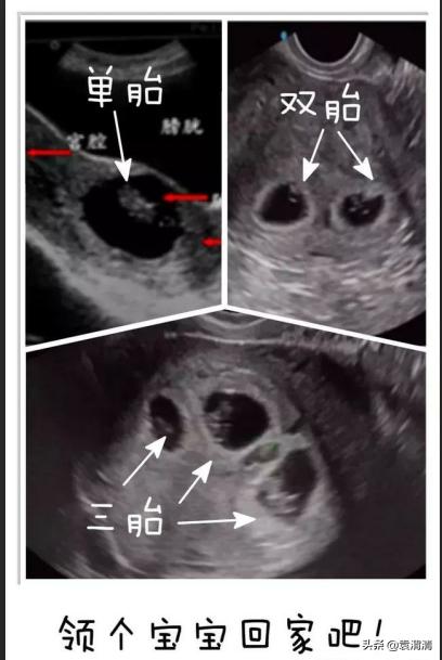 怀孕能做阴超吗,怀孕能做什么运动