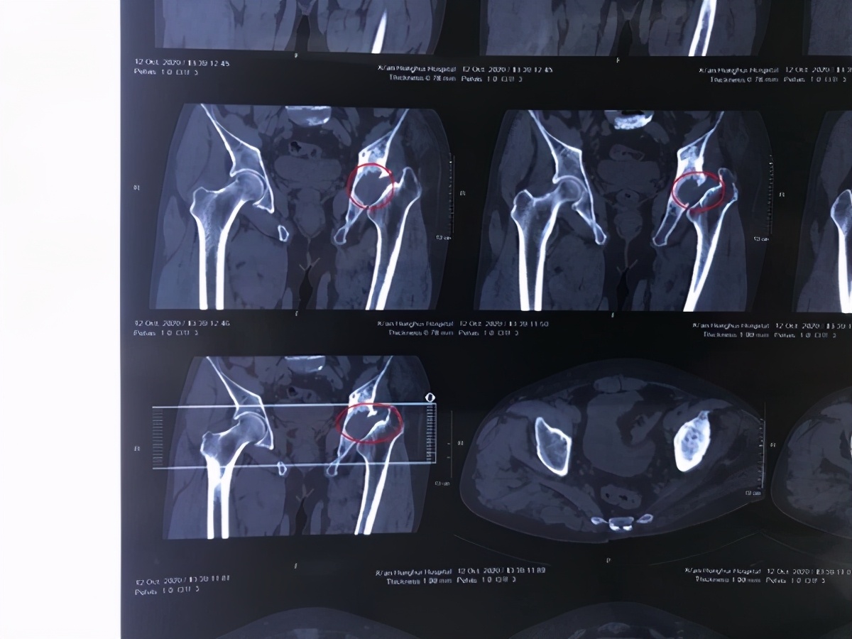 骨科专家变“神探”破获一桩“无头”案提醒：长期使用“松”字尾名激素药物的患者要定期检查股骨头状况