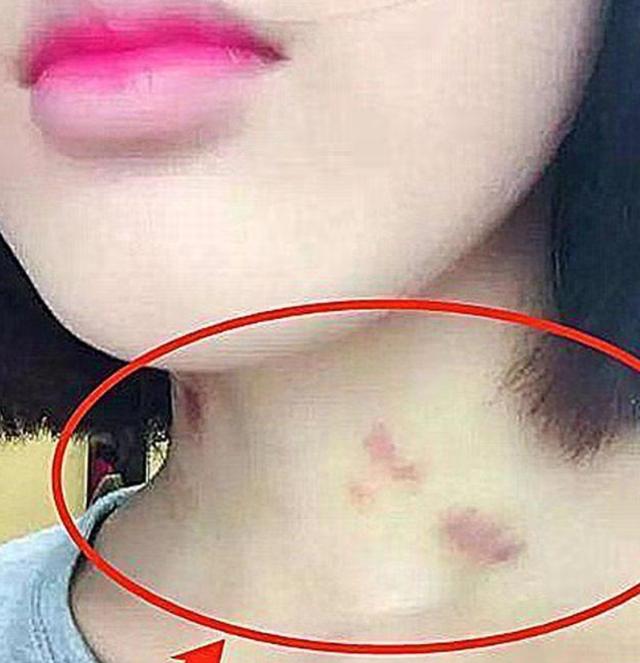 发现女儿有吻痕怎么教育,女孩颈部有吻痕父母怎样教育