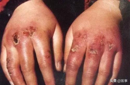 专治冻疮特效穴,冻疮有特效膏药吗