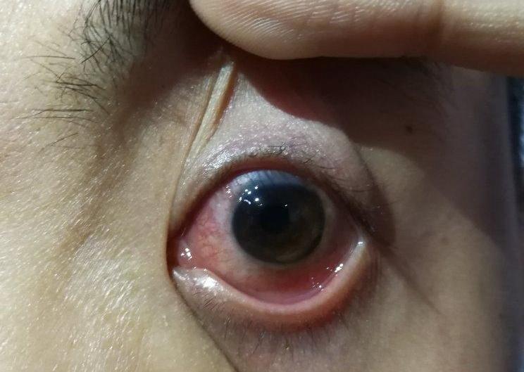 春季卡他性结膜炎影响视力,春季卡他性结膜炎眼睑有异物感