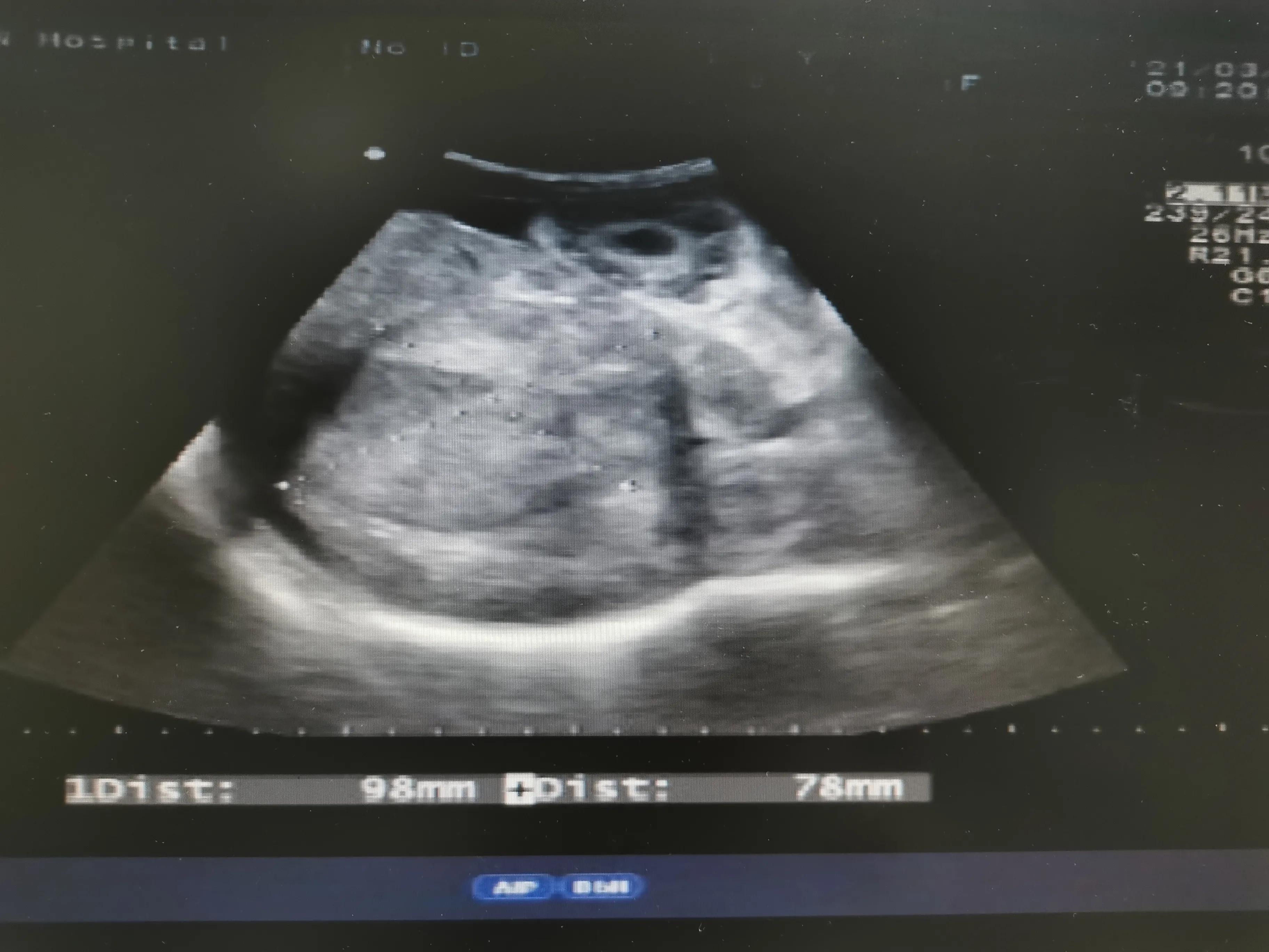 乙肝肝硬化和丙肝肝硬化的区别,乙肝肝硬化肝部占位是肝癌吗