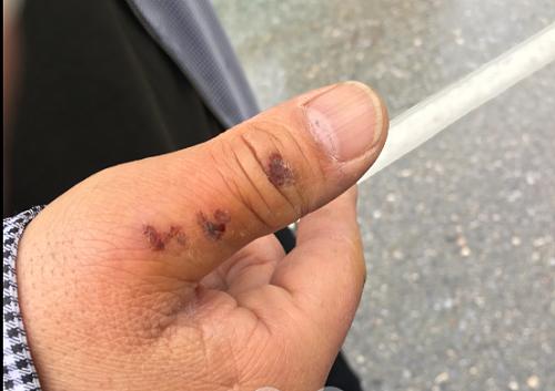 路面坑不平骑车人摔伤,因为路有坑骑车摔跤了