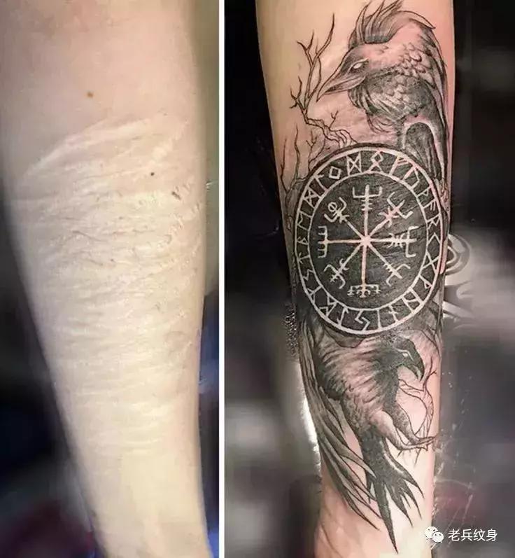 疤痕体质可以用纹身去遮盖疤痕吗,你的疤痕是什么颜色呢