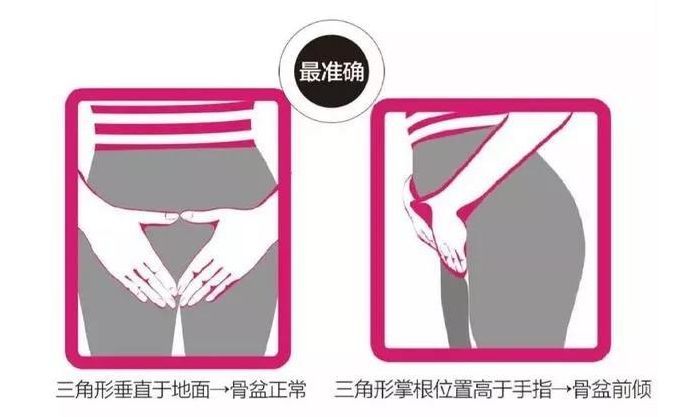 治疗骨盆前倾引起腰痛的锻炼方法,骨盆前倾腰疼纠正最快的方法