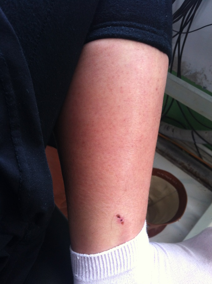 春季以来被猫狗咬伤患者增多，专家提醒应及时接受专业处置