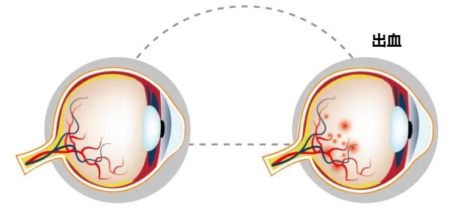 糖尿病眼底黄斑水肿打什么针好,糖尿病视网膜病变引起的黄斑水肿
