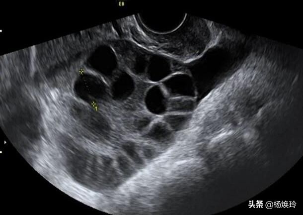 促排卵导致卵巢过度刺激综合征,又凶又险
