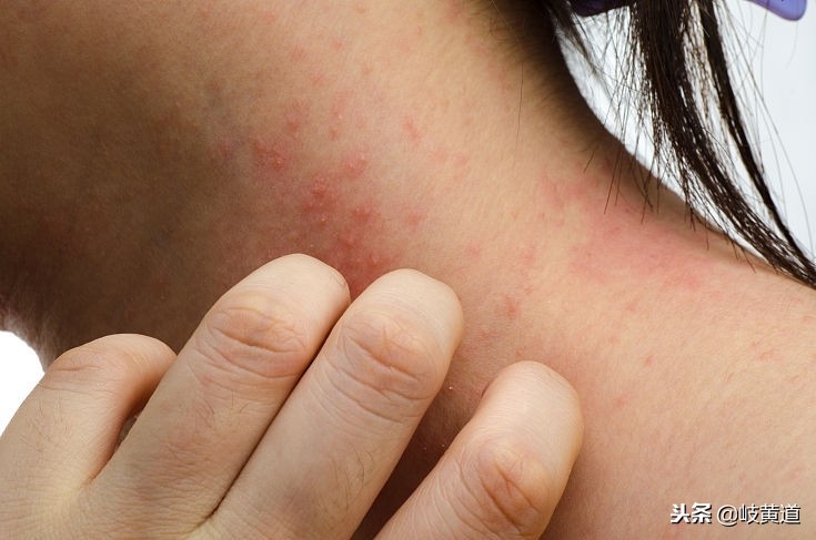 皮肤红色丘疹瘙痒,湿疹长小丘疹很严重吗