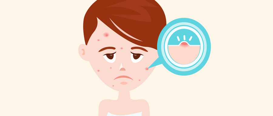 嘴唇下巴老是长痘痘是什么原因,下巴下面总是长痘痘是什么原因