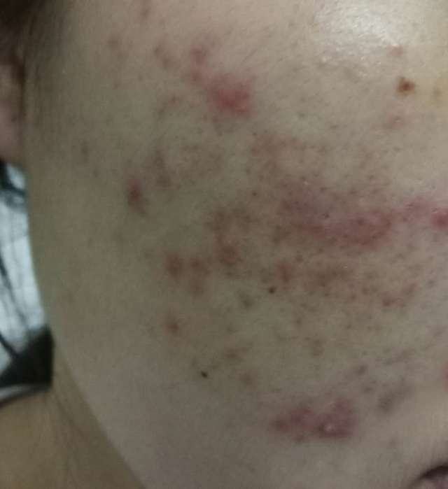 祛痘历程,祛痘经历