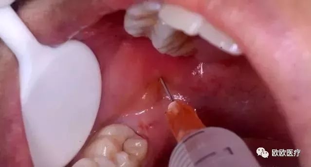 拔牙打麻药对身体有副作用吗,儿童拔牙打麻药对大脑有损害吗