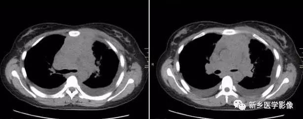 胸腺增生和纵隔肿瘤的区别和症状,纵隔胸腺肿瘤的常见临床症状表现