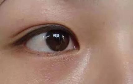 长了这么多年汗管瘤，你还以为是脂肪粒？